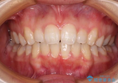 抜歯矯正の後戻り インビザライン・ライトによる矯正治療の症例 治療後