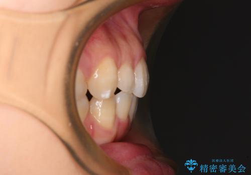 抜歯矯正の後戻り インビザライン・ライトによる矯正治療の治療後