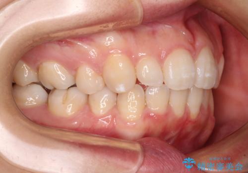 抜歯矯正の後戻り インビザライン・ライトによる矯正治療の治療後