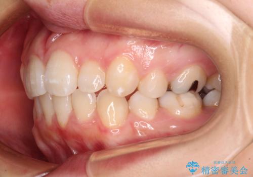 抜歯矯正の後戻り インビザライン・ライトによる矯正治療の治療後