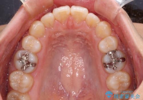 抜歯矯正の後戻り インビザライン・ライトによる矯正治療の治療後