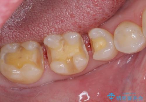 銀歯をセラミックにしたい セラミックインレー修復の治療中