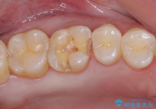 銀歯をセラミックにしたい セラミックインレー修復の治療中