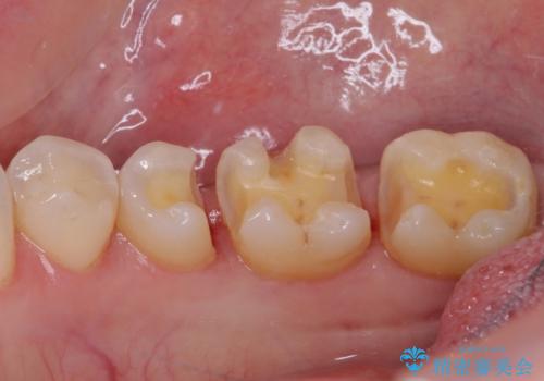 銀歯をセラミックにしたい セラミックインレー修復の治療中