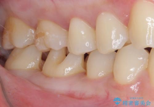 銀歯をセラミックにしたい セラミックインレー修復の治療中