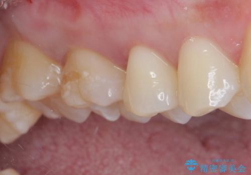 銀歯をセラミックにしたい セラミックインレー修復の治療中