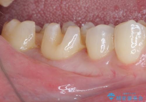 銀歯をセラミックにしたい セラミックインレー修復の治療中