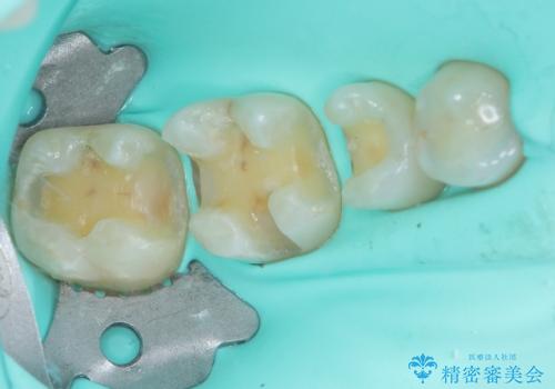 銀歯をセラミックにしたい セラミックインレー修復の治療中