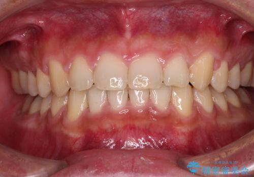 深い咬み合わせと隙間の空いた歯列をワイヤー矯正で改善の症例 治療後