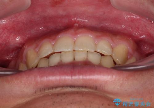 深い咬み合わせと隙間の空いた歯列をワイヤー矯正で改善の治療後