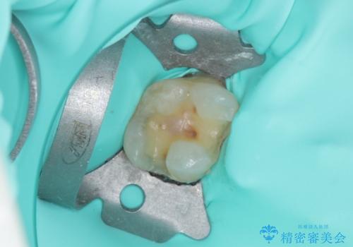 銀歯をセラミックにしたい セラミックインレー修復の治療中