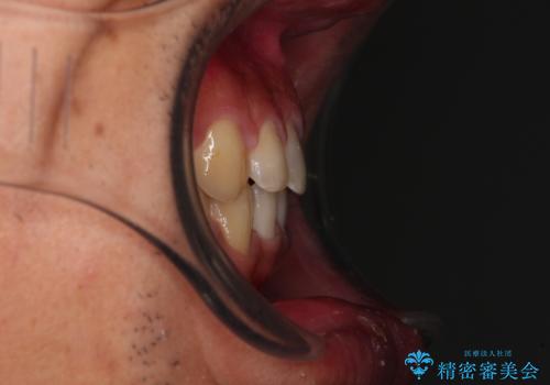 深い咬み合わせと隙間の空いた歯列をワイヤー矯正で改善の治療後