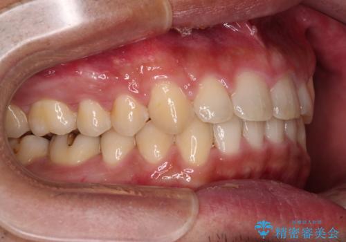 深い咬み合わせと隙間の空いた歯列をワイヤー矯正で改善の治療後