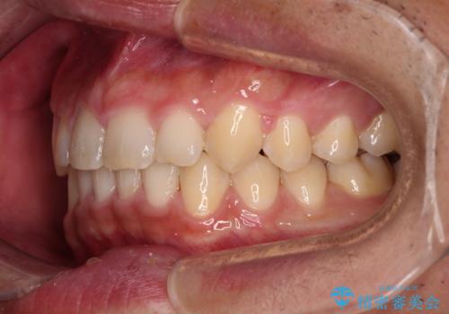 深い咬み合わせと隙間の空いた歯列をワイヤー矯正で改善の治療後
