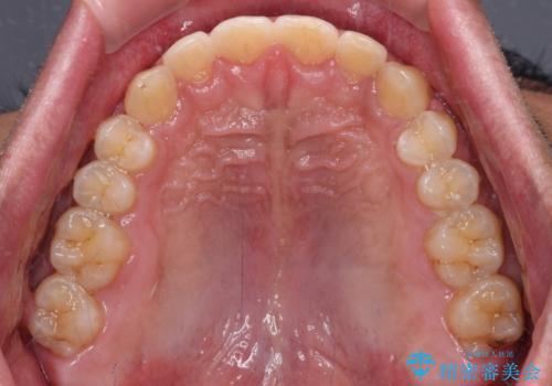 深い咬み合わせと隙間の空いた歯列をワイヤー矯正で改善の治療後