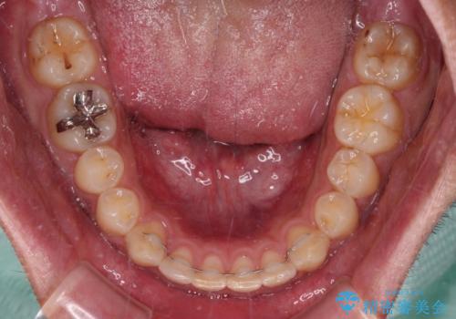 深い咬み合わせと隙間の空いた歯列をワイヤー矯正で改善の治療後