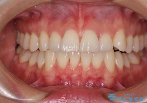 前にずれた咬み合わせをワイヤー装置でしっかりと改善の症例 治療前