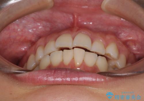 前にずれた咬み合わせをワイヤー装置でしっかりと改善の治療前