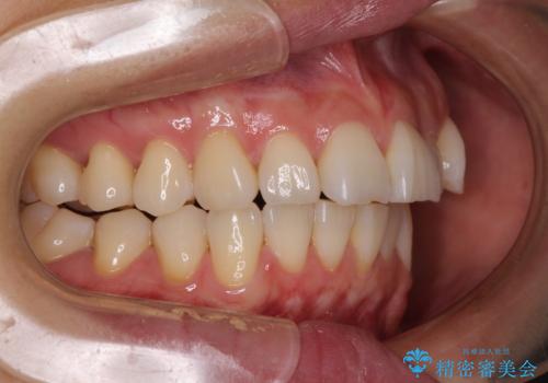 前にずれた咬み合わせをワイヤー装置でしっかりと改善の治療前