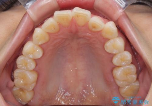 前にずれた咬み合わせをワイヤー装置でしっかりと改善の治療前