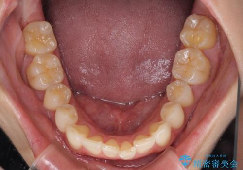 前にずれた咬み合わせをワイヤー装置でしっかりと改善の治療前