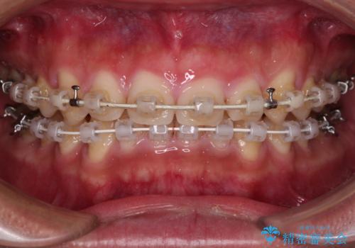 深い咬み合わせと隙間の空いた歯列をワイヤー矯正で改善の治療中
