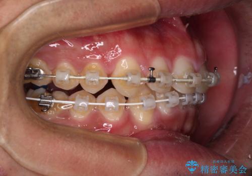 深い咬み合わせと隙間の空いた歯列をワイヤー矯正で改善の治療中