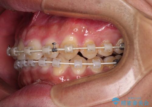 深い咬み合わせと隙間の空いた歯列をワイヤー矯正で改善の治療中