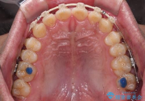 深い咬み合わせと隙間の空いた歯列をワイヤー矯正で改善の治療中