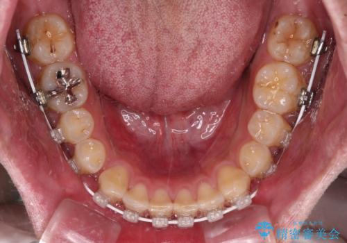 深い咬み合わせと隙間の空いた歯列をワイヤー矯正で改善の治療中