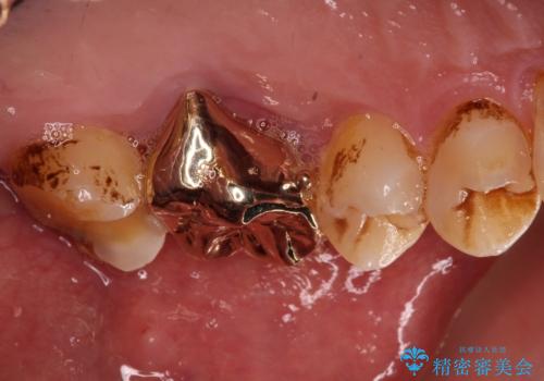 食事で割れてしまった奥歯 外科処置を用いた補綴治療の治療後