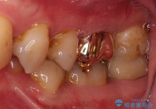 食事で割れてしまった奥歯 外科処置を用いた補綴治療の治療後