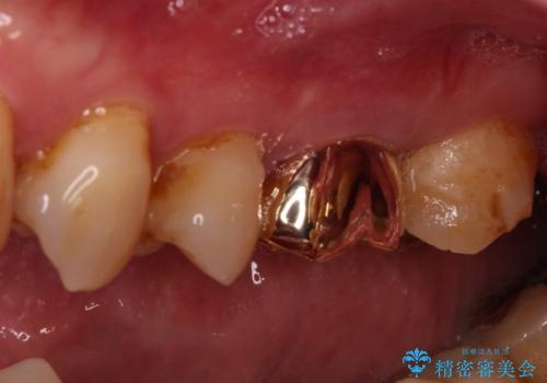 食事で割れてしまった奥歯 外科処置を用いた補綴治療の治療後