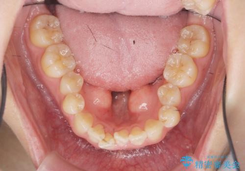 [ 下顎骨隆起の切除 ] 舌のスペースが狭く話しづらいの治療前