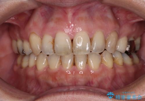 閉じにく口元と欠損歯列　ワイヤー装置の抜歯矯正の症例 治療後