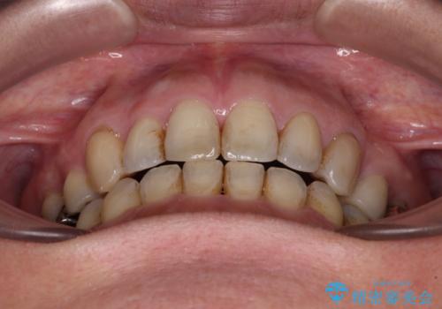 閉じにく口元と欠損歯列 ワイヤー装置の抜歯矯正の治療後