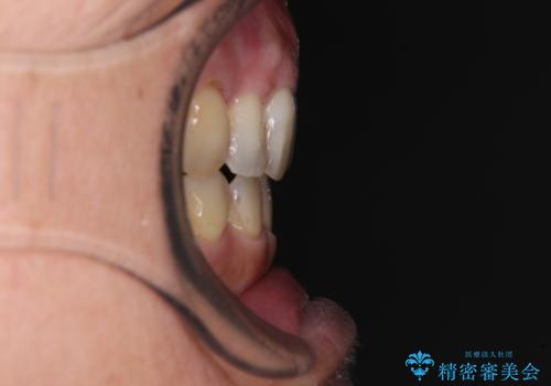 閉じにく口元と欠損歯列 ワイヤー装置の抜歯矯正の治療後