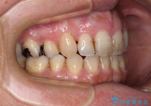 閉じにく口元と欠損歯列 ワイヤー装置の抜歯矯正の治療後