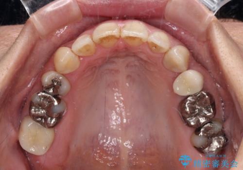 閉じにく口元と欠損歯列　ワイヤー装置の抜歯矯正の治療後