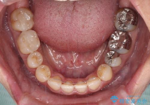 閉じにく口元と欠損歯列 ワイヤー装置の抜歯矯正の治療後