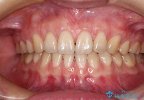 矯正治療で退縮してしまった歯肉 歯肉移植で自然な前歯にの治療後