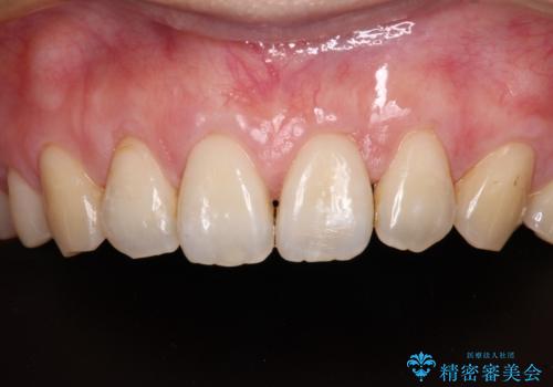 矯正治療で退縮してしまった歯肉 歯肉移植で自然な前歯にの症例 治療後