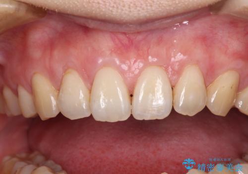 矯正治療で退縮してしまった歯肉 歯肉移植で自然な前歯にの治療後