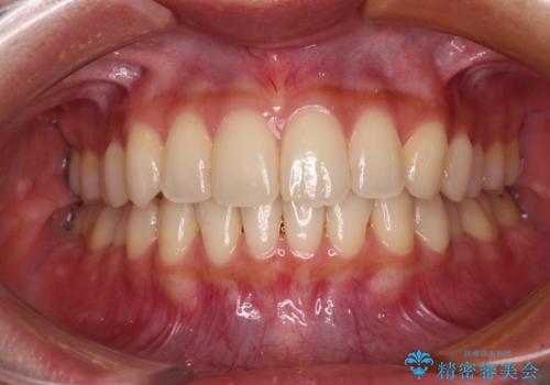 【モニター】インビザラインをしっかり使って短期間矯正治療の症例 治療後