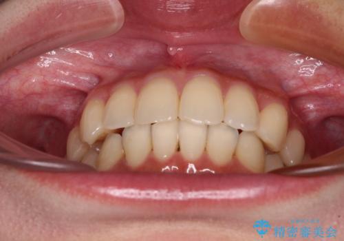 【モニター】インビザラインをしっかり使って短期間矯正治療の治療後