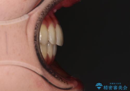 【モニター】インビザラインをしっかり使って短期間矯正治療の治療後