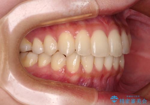 【モニター】インビザラインをしっかり使って短期間矯正治療の治療後