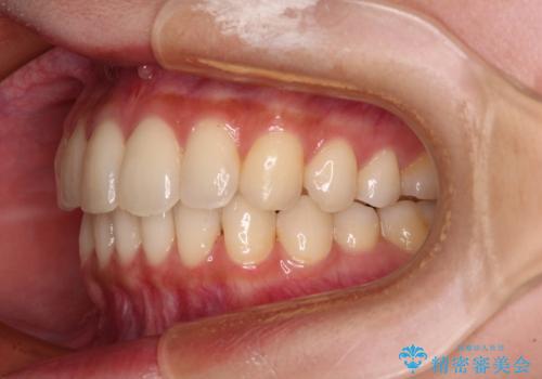 【モニター】インビザラインをしっかり使って短期間矯正治療の治療後