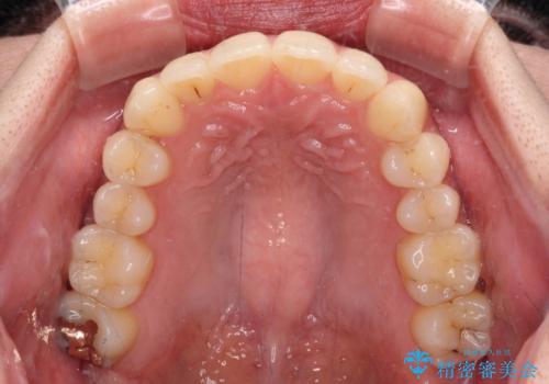 【モニター】インビザラインをしっかり使って短期間矯正治療の治療後