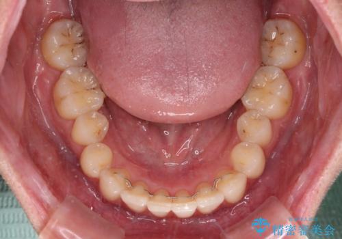 【モニター】インビザラインをしっかり使って短期間矯正治療の治療後